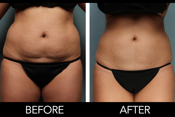 Body-Contouring-Before-After-3