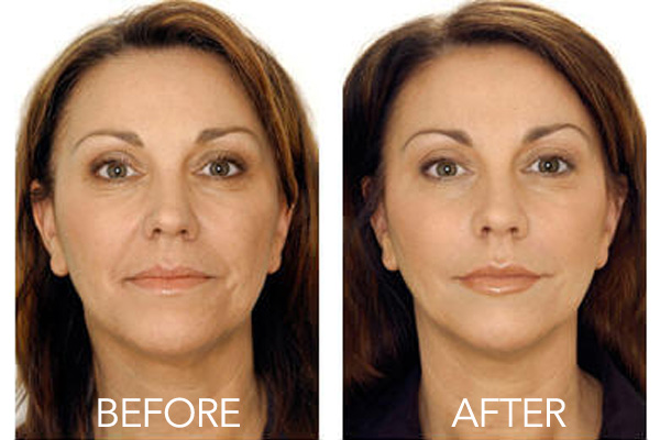 Facial-Skin-Boost-Before-After-2